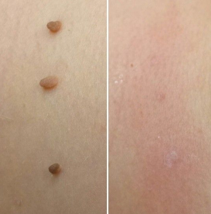 Relievu TagAway Kit Pro™ – Clear Skin Starts Here (Copy)