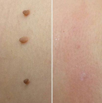 Relievu TagAway Kit Pro™ – Clear Skin Starts Here (Copy)